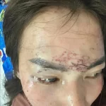 顔に刺青を入れられた被害者