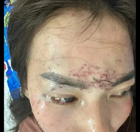 顔に刺青を入れられた被害者